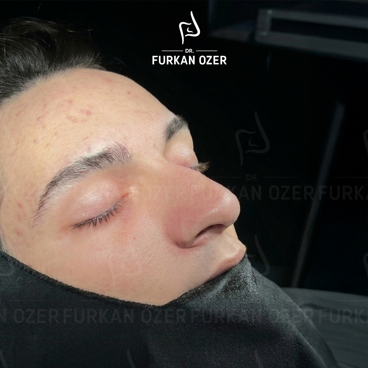 Estetik cerrahi öncesi - Dr. Furkan Özer