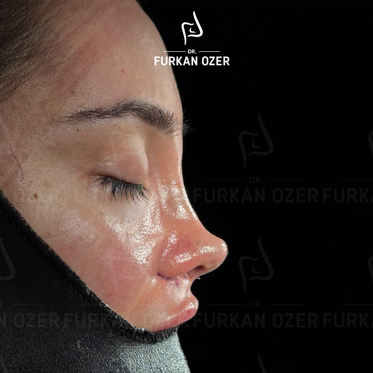 Estetik cerrahi sonrası sonuç - Dr. Furkan Özer