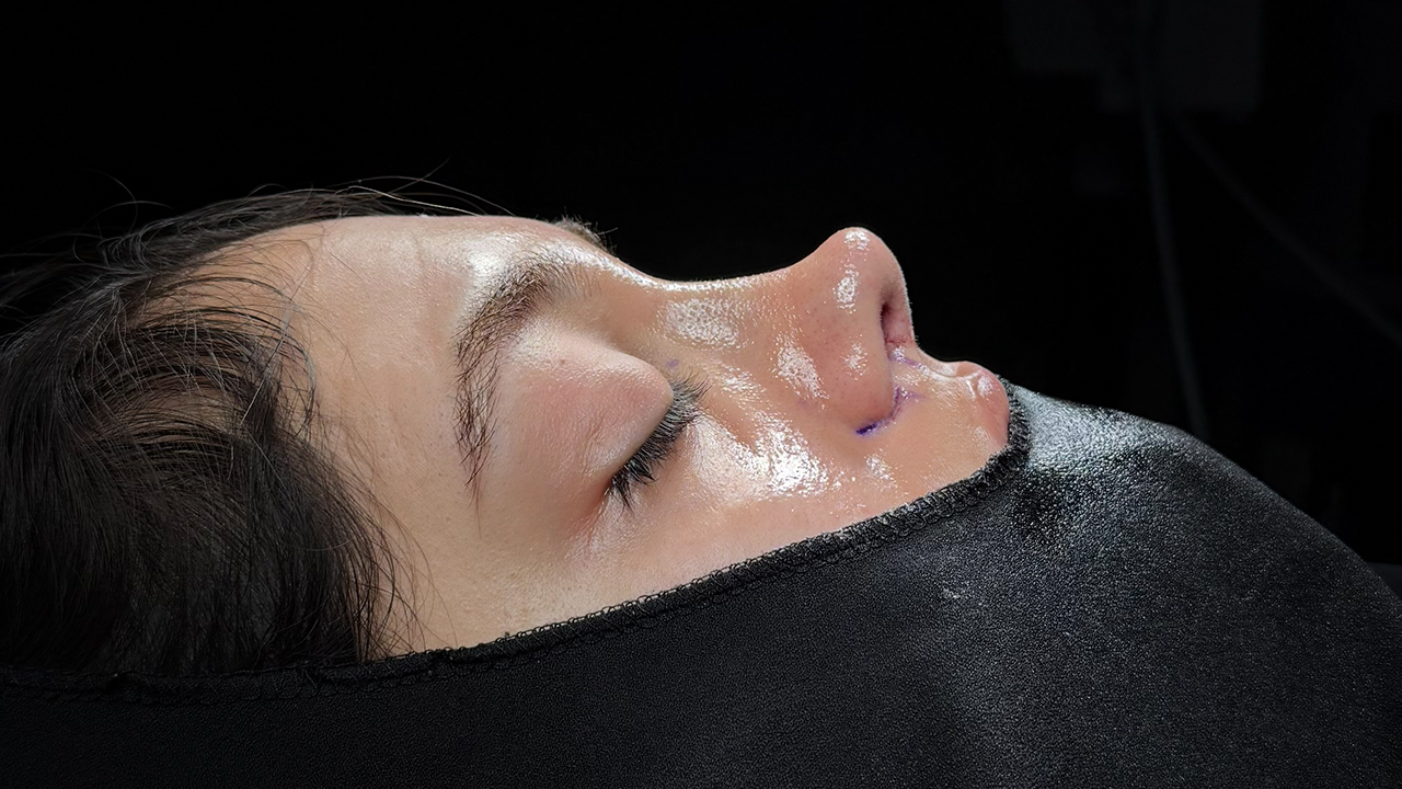Septorhinoplasty