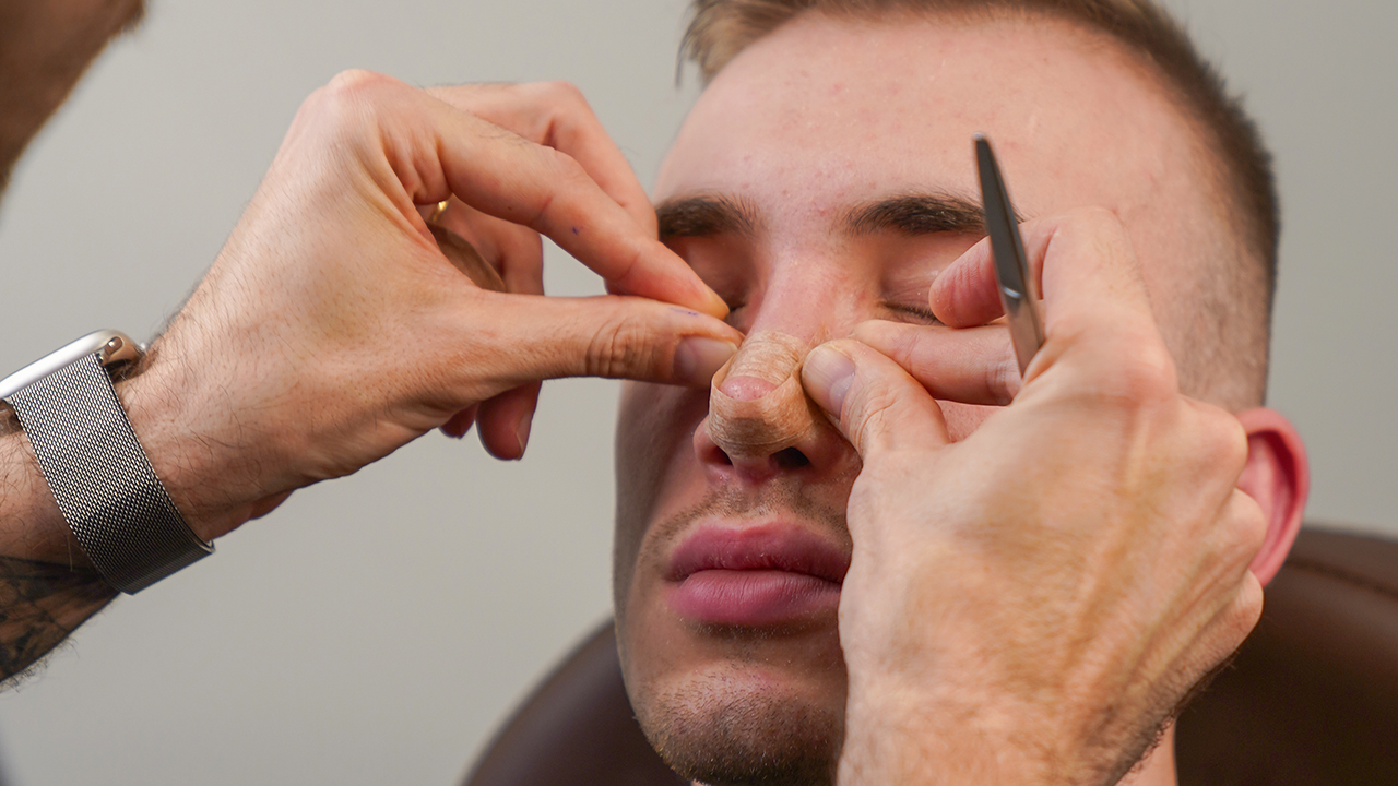 Revision Rhinoplasty